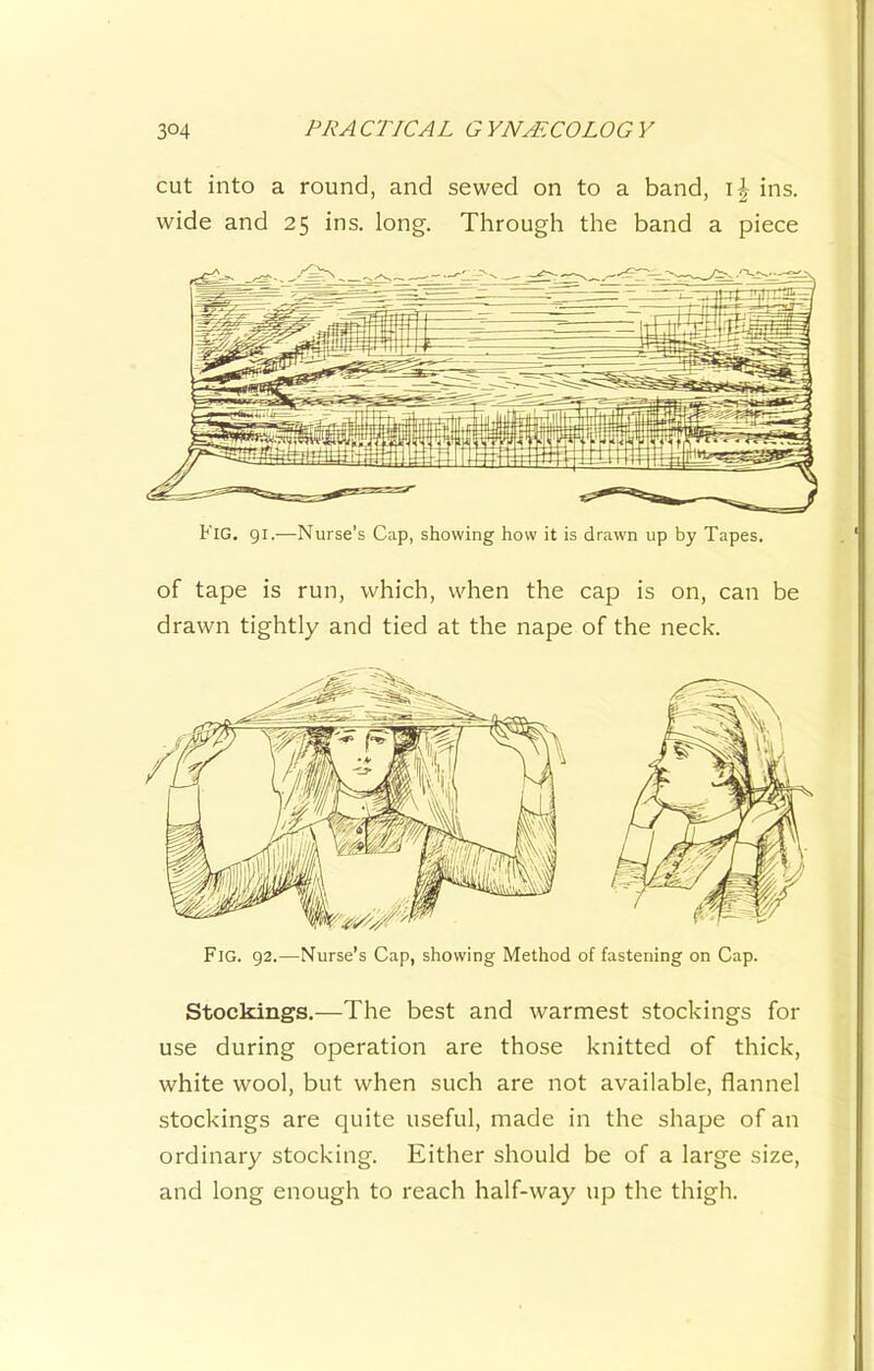 cut into a round, and sewed on to a band, \ \ ins. wide and 25 ins. long. Through the band a piece Fig. gi.—Nurse’s Cap, showing how it is drawn up by Tapes. of tape is run, which, when the cap is on, can be drawn tightly and tied at the nape of the neck. Fig. 92.—Nurse’s Cap, showing Method of fastening on Cap. Stockings.—The best and warmest stockings for use during operation are those knitted of thick, white wool, but when such are not available, flannel stockings are quite useful, made in the shape of an ordinary stocking. Either should be of a large size, and long enough to reach half-way up the thigh. iiiliiJP