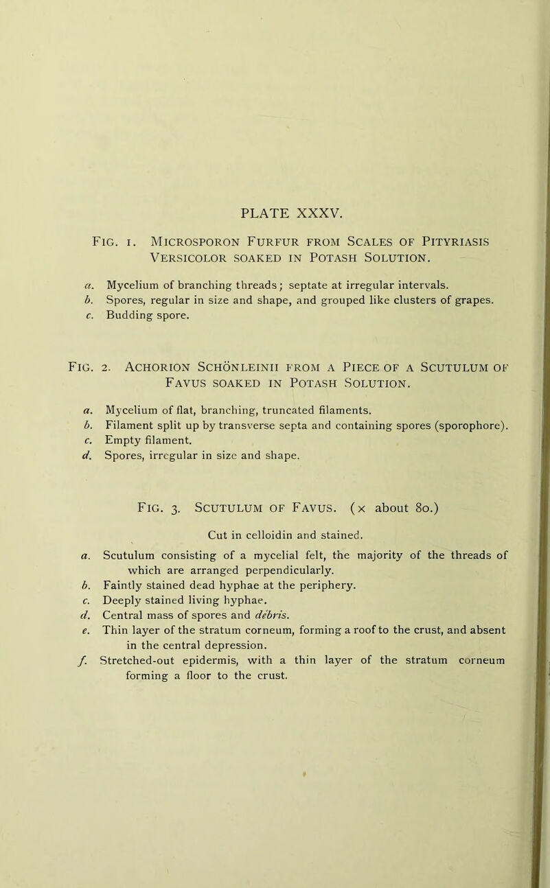 Fig. i. Microsporon Furfur from Scales of Pityriasis Versicolor soaked in Potash Solution. a. Mycelium of branching threads; septate at irregular intervals. b. Spores, regular in size and shape, and grouped like clusters of grapes. c. Budding spore. Fig. 2. Achorion Schonleinii from a Piece of a Scutulum of Favus soaked in Potash Solution. a. Mycelium of flat, branching, truncated filaments. b. Filament split up by transverse septa and containing spores (sporophore). c. Empty filament. d. Spores, irregular in size and shape. Fig. 3. Scutulum of Favus. (x about 80.) Cut in celloidin and stained. a. Scutulum consisting of a mycelial felt, the majority of the threads of which are arranged perpendicularly. b. Faintly stained dead hyphae at the periphery. c. Deeply stained living hyphae. d. Central mass of spores and debris. e. Thin layer of the stratum corneum, forming a roof to the crust, and absent in the central depression. /. Stretched-out epidermis, with a thin layer of the stratum corneum forming a floor to the crust.