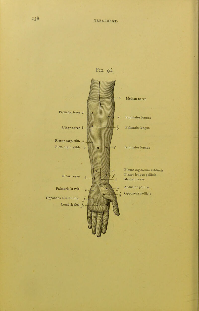 TREATMENT. Fig. 96. Pronator teres S Ulnar nerve 2 Median ner\-e e Supinator longus Palmaris longus Flexor carp. uln. / Flex, digit, subl. c Supinator longus Ulnar nerve Palmaris brevii Opponens minimi dig. j Lumbricales A Flexor digitorum sublimis J? Flexor longus pollicis \^ Median nerve _ fj Abductor pollicis ^ Opponens pollicis