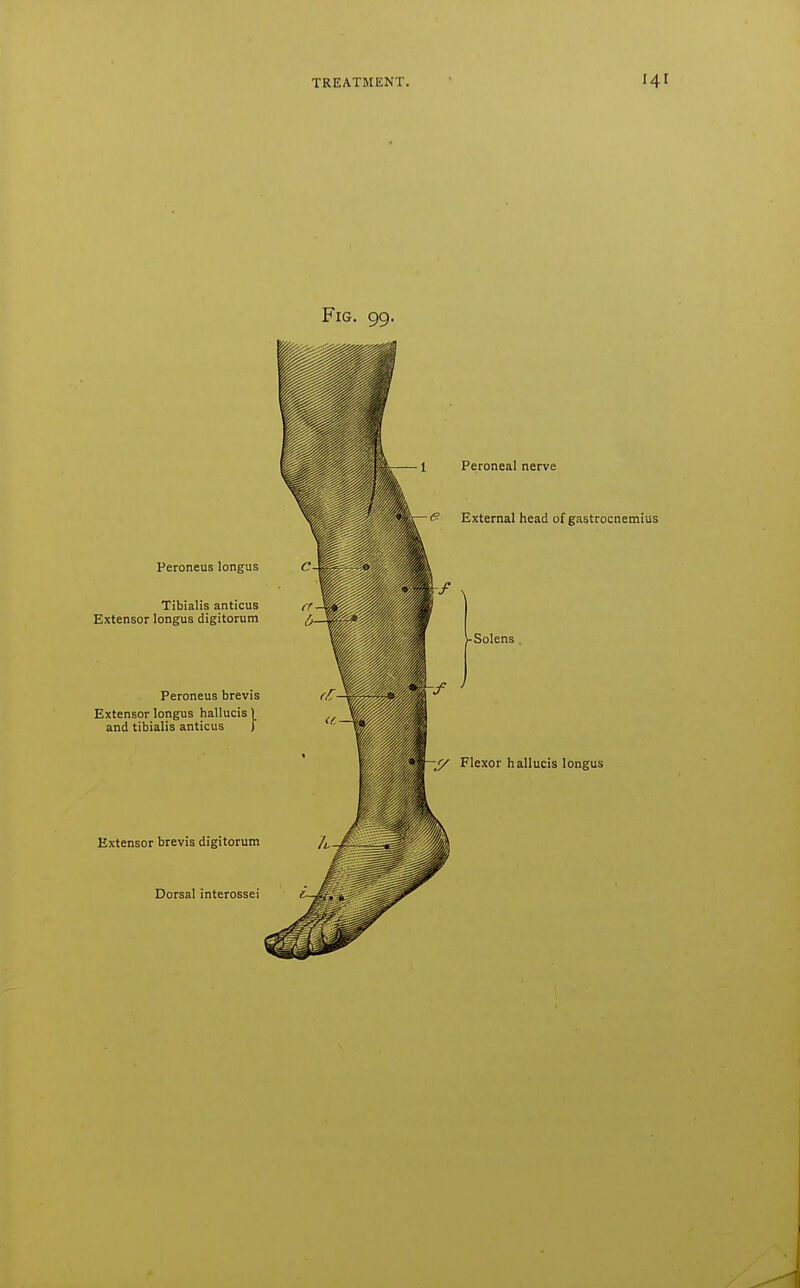 Fig. 99. Peroneus longus Tibialis anticus Extensor longus digitorum Peroneus brevis Extensor longus hallucis 1 and tibialis anticus { Extensor brevis digitorum Dorsal interossei I Peroneal nerve <^ External head of gastrocnemius -Solens . ^ Flexor hallucis longus