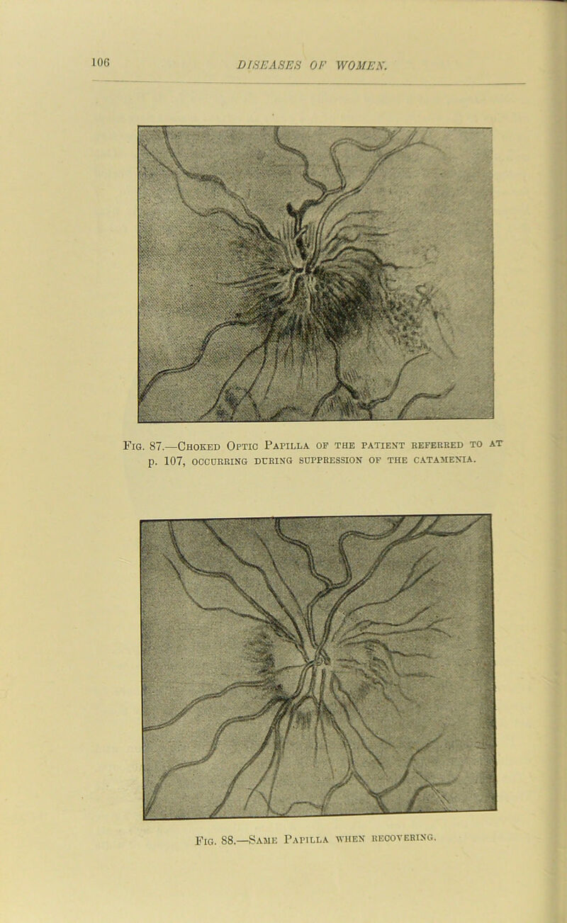 10G Fig. 87.—Choked Optic Papilla op the patient kefebbed to at p. 107, OCCUBBING DURING SUPPRESSION OF THE CATAMENIA. Fig. 88.—Same Papilla when recovering.