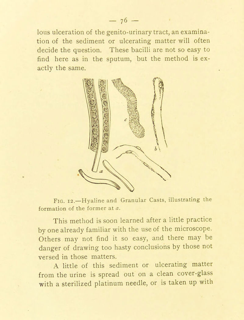 lous ulceration of the genito-urinary tract, an examina- tion of the sediment or ulcerating matter will often decide the question. These bacilli are not so easy to find here as in the sputum, but the method is ex- actly the same. Fig. 12.—Hyaline and Granular Casts, illustrating the formation of the former at a. This method is soon learned after a little practice by one already familiar with the use of the microscope. Others may not find it so easy, and there may be danger of drawing too hasty conclusions by those not versed in those matters. A little of this sediment or ulcerating matter from the urine is spread out on a clean cover-glass with a sterilized platinum needle, or is taken up with