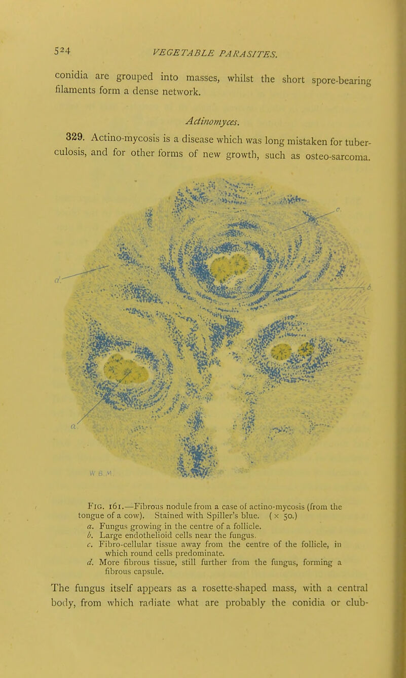 conidia are grouped into masses, whilst the short spore-bearing filaments form a dense network. Actinomyces. 329. Actino-mycosis is a disease which was long mistaken for tuber- culosis, and for other forms of new growth, such as osteo-sarcoma. dr • A<.>J*»;(Tr>. •ix..; '•■ ;V.» rPKU''-._ •■:1> • , ■•■ '>i Fig. i6i.—Fibrous nodule from a case of actino-mycosis (from the tongue of a cow). Stained with Spiller's blue. ( x 50.) a. Fungus growing in the centre of a follicle. i. Large endothelioid cells near the fungus. f. Fibro-cellular tissue away from the centre of the follicle, in which round cells predominate. d. More fibrous tissue, still further from the fungus, forming a fibrous capsule. The fungus itself appears as a rosette-shaped mass, with a central body, from which radiate what are probably the conidia or club-