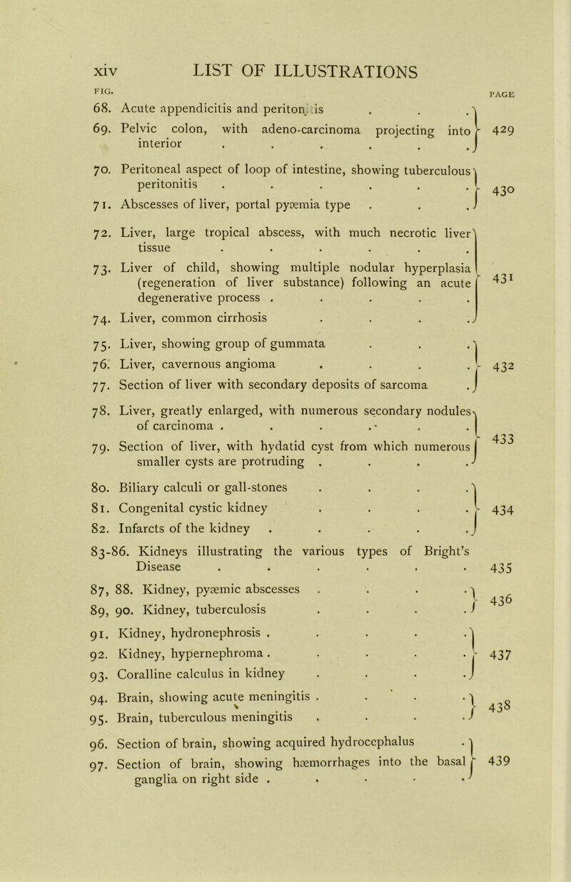 FIG. 68. Acute appendicitis and periton is 69. Pelvic colon, with adeno-carcinoma projecting into interior .... 70. Peritoneal aspect of loop of intestine, showing tuberculous'! peritonitis . . . . . ! 71. Abscesses of liver, portal pyaemia type . . . J 72. Liver, large tropical abscess, with much necrotic liver' tissue ...... 73. Liver of child, showing multiple nodular hyperplasia (regeneration of liver substance) following an acute degenerative process ..... 74. Liver, common cirrhosis 75. Liver, showing group of gummata 76. Liver, cavernous angioma 77. Section of liver with secondary deposits of sarcoma 1 .7 78. Liver, greatly enlarged, with numerous secondary nodules of carcinoma . 79. Section of liver, with hydatid cyst from which smaller cysts are protruding . Bright’s •1 J 80. Biliary calculi or gall-stones 81. Congenital cystic kidney 82. Infarcts of the kidney 83-86. Kidneys illustrating the various types of Disease 87, 88. Kidney, pyaemic abscesses 89, 90. Kidney, tuberculosis 91. Kidney, hydronephrosis . 92. Kidney, hypernephroma . 93. Coralline calculus in kidney 94. Brain, showing acute meningitis . 95. Brain, tuberculous meningitis 96. Section of brain, showing acquired hydrocephalus 97. Section of brain, showing haemorrhages into the basal j ganglia on right side . . - • ■ ' nimerous •l l :/ ./ PAGE 429 430 431 432 433 434 435 436 437 438 439