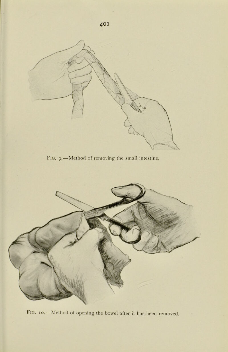 40] Fig. 9.—Method of removing the small intestine. hiG. 10.—Method of opening the bowel after it has been removed.