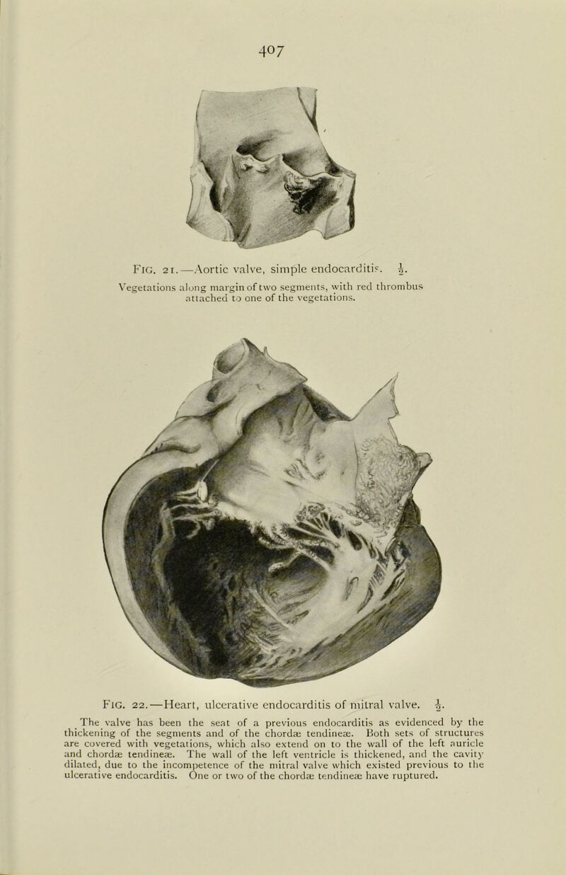 Fig. 21.—Aortic valve, simple endocarditis, i. Vegetations along margin of two segments, with red thrombus attached to one of the vegetations. Fig. 22.—Heart, ulcerative endocarditis of mitral valve. The valve has been the seat of a previous endocarditis as evidenced by the thickening of the segments and of the chorda; tendineae. Both sets of structures are covered with vegetations, which also extend on to the wall of the left auricle and chordae tendine$. The wall of the left ventricle is thickened, and the cavity dilated, due to the incompetence of the mitral valve which existed previous to the ulcerative endocarditis. One or two of the chordae tendineae have ruptured.