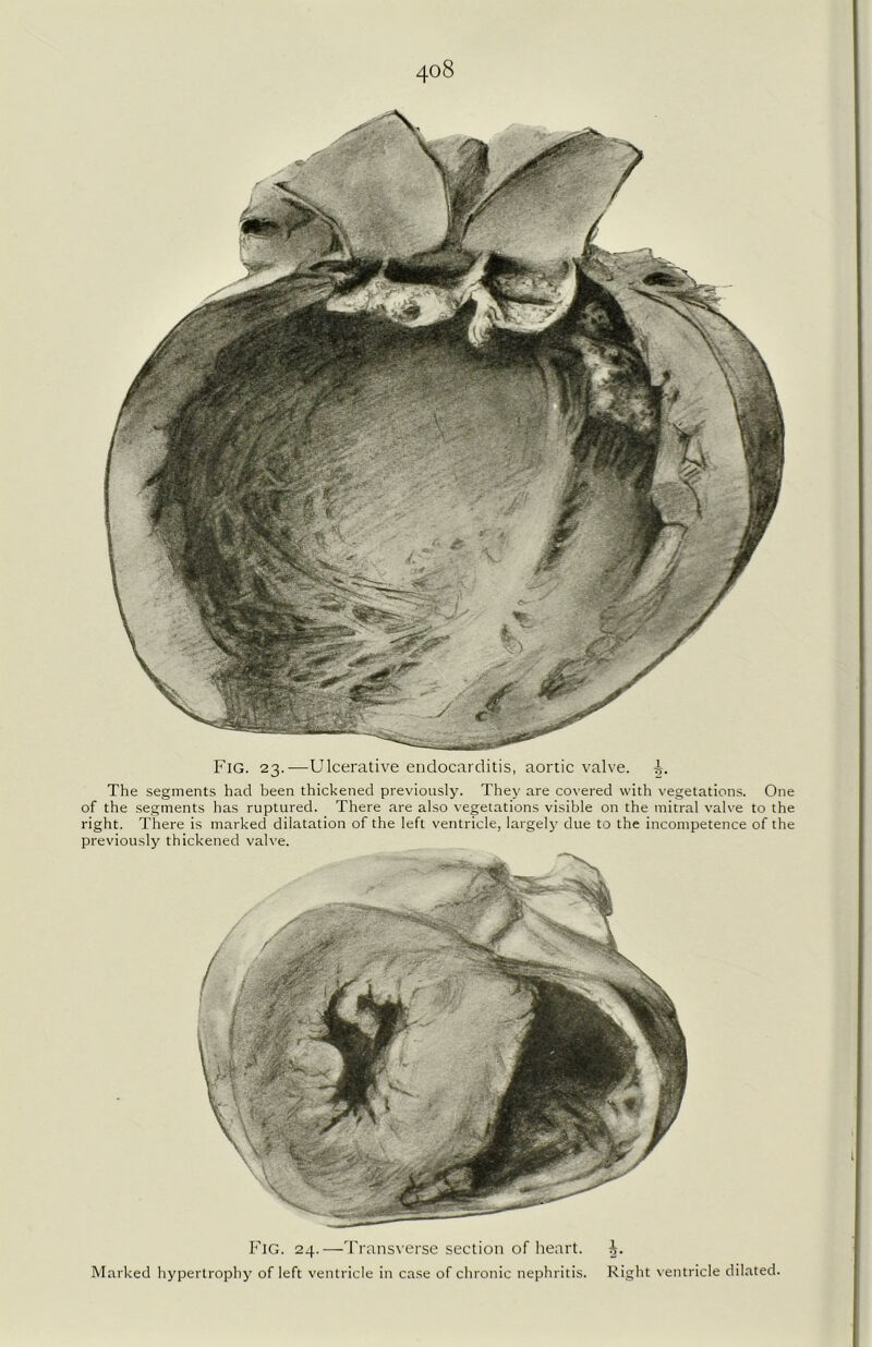 The segments hacl been thickened previously. They are covered with vegetations. One of the segments has ruptured. There are also vegetations visible on the mitral valve to the right. There is marked dilatation of the left ventricle, largely due to the incompetence of the previously thickened valve. Fig. 24.—Transverse section of heart. Marked hypertrophy of left ventricle in case of chronic nephritis. Right ventricle dilated.