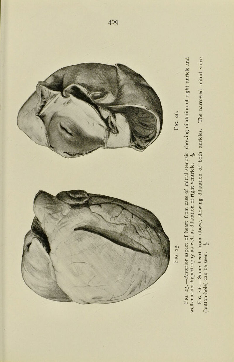 Fig. 25.—Anterior aspect of heart from case of mitral stenosis, showing dilatation of right auricle and well-marked hypertrophy as well as dilatation of right ventricle. Fig. 26.—Same heart from above, showing dilatation of both auricles. The narrowed mitral valve (button-hole) can be seen.