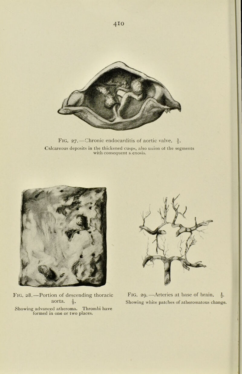 4io Fig. 27.—Chronic endocarditis of aortic valve. Calcareous deposits in the thickened cusps, also union ot the segments with consequent s.enosis. Fig. 28. — Portion of descending thoracic aorta. Showing advanced atheroma. Thrombi have formed in one or two places. Fig. 29.—Arteries at base of brain, Showing white patches of atheromatous change.