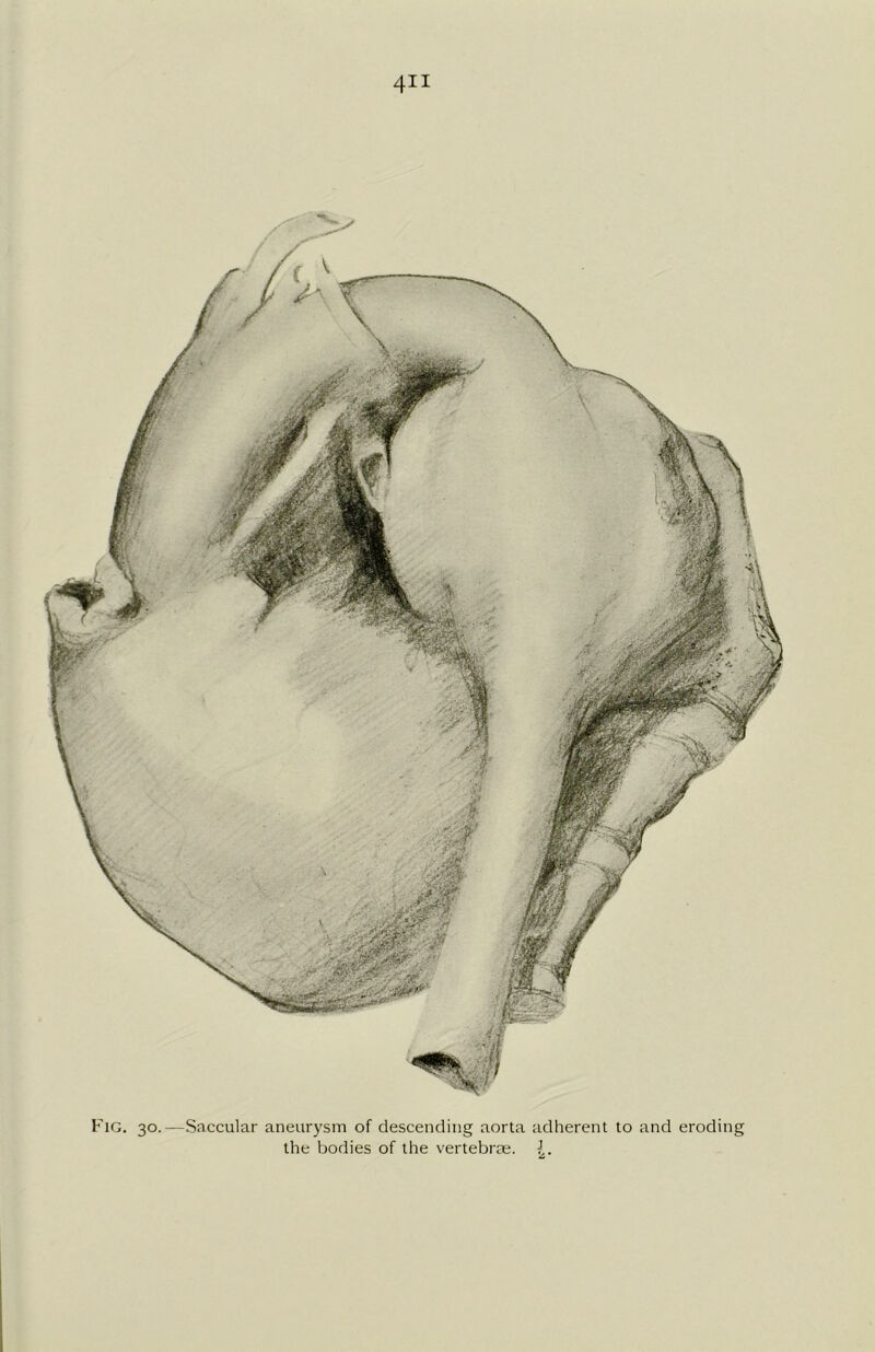 Fig. 30.—Saccular aneurysm of descending aorta the bodies of the vertebrae. adherent to and eroding 1 2 •