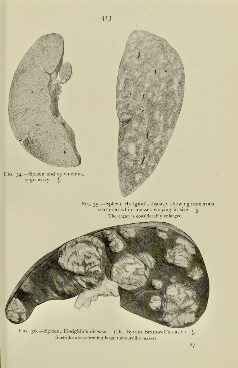 4^3 Fig. 35.—-Spleen, Hodgkin’s disease, showing numerous scattered white masses varying in size. i. The organ is considerably enlarged. Fig. 36.—Spleen, Hodgkin’s disease. (Dr. Byrom Bramwell’s case.) Suet-like areas forming large tumour-like masses. 2?