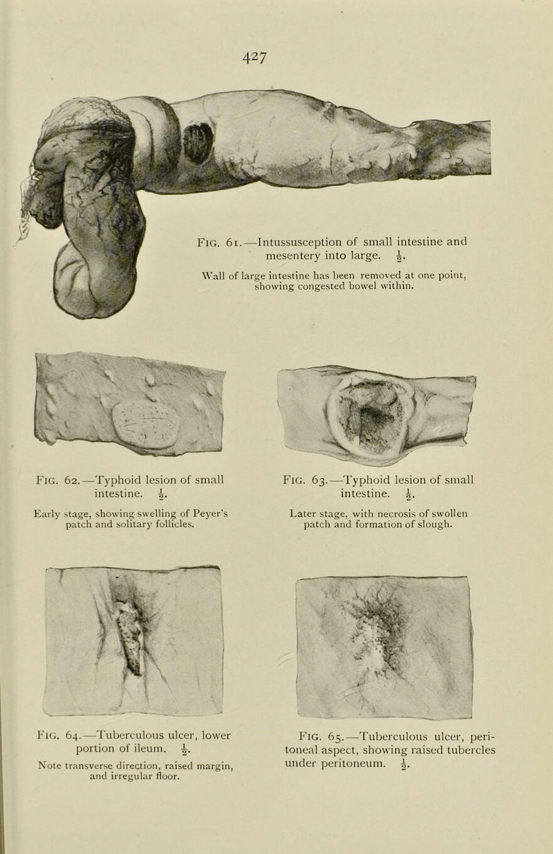 Fig. 6i.—Intussusception of small intestine and mesentery into large. Wall of large intestine has been removed at one point, showing congested bowel within. Fig. 62.—Typhoid lesion of small intestine, Fig. 63.—Typhoid lesion of small intestine. 5. Early stage, showing swelling of Peyer's patch and solitary follicles. Later stage, with necrosis of swollen patch and formation of slough. Fig. 64.—Tuberculous ulcer, lower portion of ileum. Note transverse direction, raised margin, and irregular floor. Fig. 65.—Tuberculous ulcer, peri- toneal aspect, showing raised tubercles under peritoneum.