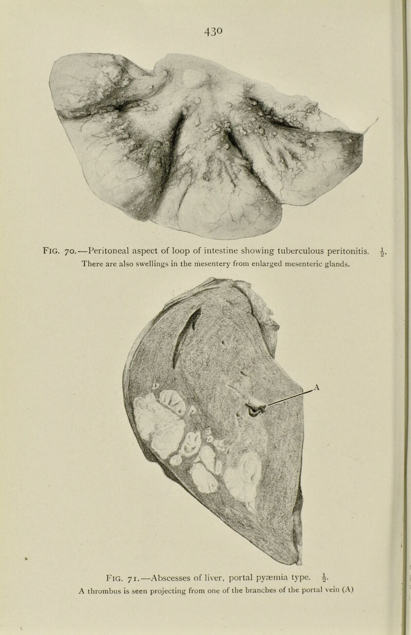 Fig. 70.—Peritoneal aspect of loop of intestine showing tuberculous peritonitis. There are also swellings in the mesentery from enlarged mesenteric glands. Fig. 71.—Abscesses of liver, portal pyaemia type. i. A thrombus is seen projecting from one of the branches of the portal vein (A) ioIm