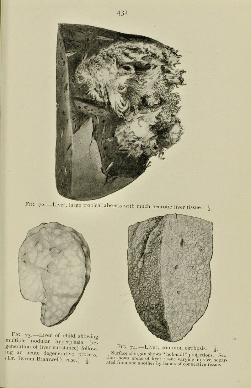 Fig. 72. Liver, large tropical abscess with much necrotic liver tissue. A. F[G- 73-—Liver of child showing multiple nodular hyperplasia (re- generation of liver substance) follow- ing an acute degenerative process. (L>r. Byrom Bramwell's case.) 1. Fig. 74.—Liver, common cirrhosis. A. . Sui face of organ shows “ hob-nail ” projections. Sec- tion shows areas of liver tissue varying in size, separ- ated from one another by bands of connective tissue.