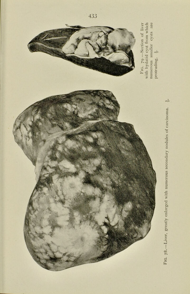 Fig. 78.—Liver, greatly enlarged with numerous secondary nodules of carcinoma.