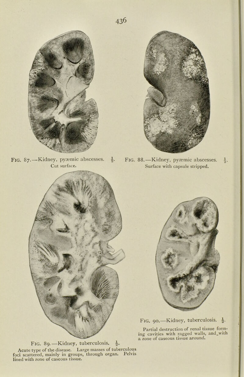 43& Fig. 87.—Kidney, pyaemic abscesses. Cut surface. Fig. 88.—Kidney, pyaemic abscesses. Surface with capsule stripped. Fig. 90.—Kidney, tuberculosis. Partial destruction of renal tissue form- ing cavities with ragged walls, and„with a zone of caseous tissue around. Fig. 89.—Kidney, tuberculosis, i. Acute type of the disease. Large masses of tuberculous foci scattered, mainly in groups, through organ. Pelvis lined with zone of caseous tissue. 1