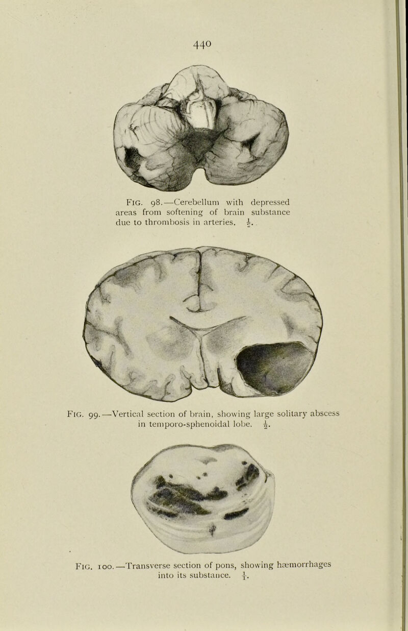 Fig. 98.-—-Cerebellum with depressed areas from softening of brain substance due to thrombosis in arteries, Fig. 99.—Vertical section of brain, showing large solitary abscess in temporo-sphenoidal lobe. i. Fig. 100.—Transverse section of pons, showing haemorrhages into its substance, -j;. ‘