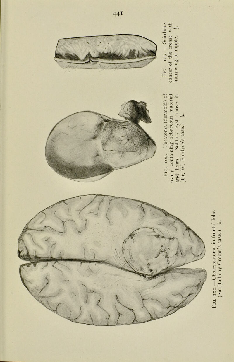 in r- 3 ~ ?'> u_( *o <2 aJ 'n t 1 *-« >a 1 ^ c • <d CO r-1 O «-• u— o M u_ b/) O • . > Fig ncei aJ ^5 CZ U £ u— o .t=: ^^ i—i Tj 22 a; 'o 5 s c* c C £> Cu 5 CJ ct CJ aJ m o Cu -4—1 d> CJ Cu m Cu c/) ra3 b f) i-CC 'CD c—i c O CJ *“ | Cfl — Tj oi Co O o r- in [Jh M o . ~ CJ Cu a ’ 1 >> Cu To s-T > c Q o Cu -—' Fig. ioi.—Cholesteatoma in frontal lobe. (Sir Halliday Croom’s case.) ■§.