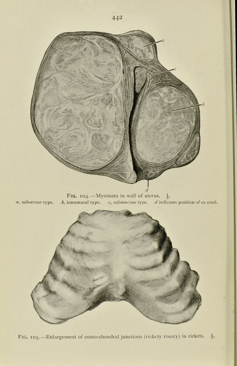 a, subserous type. d Fig. 104.—Myomata in wall of uterus. A. b, intramural type. c, submucous type. d indicates position of os uteri. Fig. 105.—Enlargement of costo-chondral junctions (rickety rosary) in rickets. A.