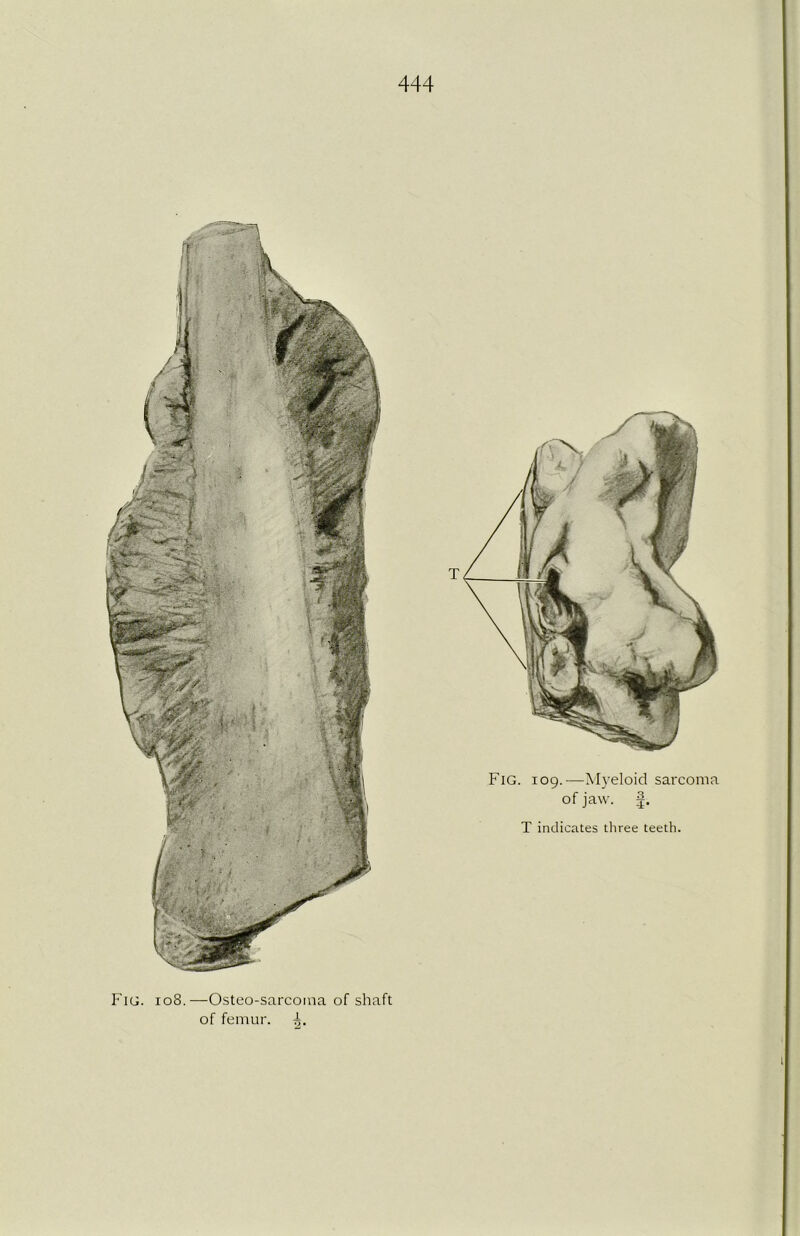 Fig. 109.—Myeloid sarcoma of jaw. T indicates three teeth. Fig. 108.—Osteo-sarcoma of shaft of femur, 1