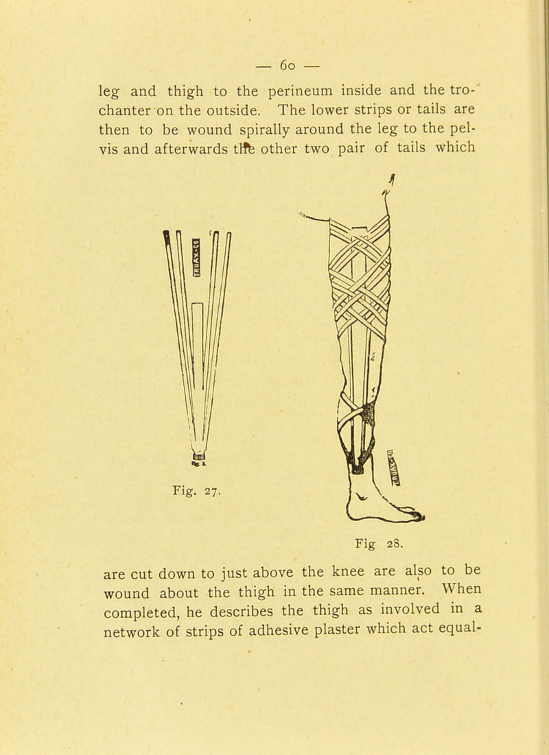 leg and thigh to the perineum inside and the tro- chanter on the outside. The lower strips or tails are then to be wound spirally around the leg to the pel- vis and afterwards tlffe other two pair of tails which Fig 28. are cut down to just above the knee are also to be wound about the thigh in the same manner. When completed, he describes the thigh as involved in a network of strips of adhesive plaster which act equal-