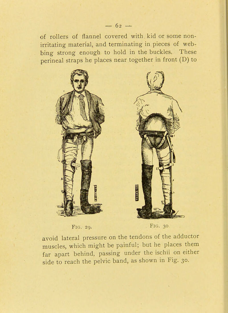 of rollers of flannel covered with. kid or some non- irritating material, and terminating in pieces of web- bing strong enough to hold in the buckles. These perineal straps he places near together in front (D) to Fig. 29. Fig. 30. avoid lateral pressure on the tendons of the adductor muscles, which might be painful; but he places them far apart behind, passing under the ischii on either side to reach the pelvic band, as shown in Fig. 30.