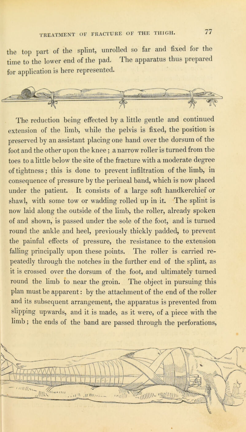 TREATMENT OF FRACTURE OF THE THIGH. tliG top pRi’t of tliG splintj LinrollGcl so fill 3.nd fixod. for the tiiBG to tliG lowGr Gild of thG pad. Tho apparatus thus proparod for application is here roprosGiitod. Tho roduction being ofFoctod by a littlo gGiitlo and continuod GxtGiision of tliG limb, whilo tho polvis is fixod, tho position is prGSGrvGd by an assistant placing one hand over the dorsum of the foot and the other upon the knee; a narrow roller is turned from the toes to a little below the site of the fracture with a moderate degree of tightness; this is done to prevent infiltration of the limb, in consequence of pressure by the perineal band, which is now placed under the patient. It consists of a large soft handkerchief or shawl, with some tow or wadding rolled up in it. The splint is now laid along the outside of the limb, the roller, already spoken of and shown, is passed under the sole of the foot, and is turned round the ankle and heel, previously thickly padded, to prevent the painful effects of pressure, the resistance to the extension falling principally upon these points. The roller is carried re- peatedly through the notches in the further end of the splint, as it is crossed over the dorsum of the foot, and ultimately turned round the limb to near the groin. The object in pursuing this plan must be apparent: by the attachment of the end of the roller and its subsequent arrangement, the apparatus is prevented from slipping upwards, and it is made, as it were, of a piece with the limb; the ends of the band are passed through the perforations.