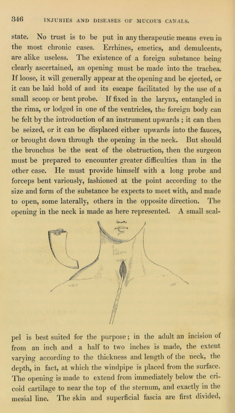 state. No trust is to be put in any therapeutic means even in the most chronic cases. Errhines, emetics, and demulcents, are alike useless. The existence of a foreign substance being clearly ascertained, an opening must be made into the trachea. If loose, it will generally appear at the opening and be ejected, or it can be laid hold of and its escape facilitated by the use of a small scoop or bent probe. If fixed in the larynx, entangled in the rima, or lodged in one of the ventricles, the foreign body can be felt by the introduction of an instrument upwards ; it can then he seized, or it can be displaced either upwards into the fauces, or brought down through the opening in the neck. But should the bronchus be the seat of the obstruction, then the surgeon must be prepared to encounter greater difficulties than in the other case. He must provide himself with a long probe and forceps bent variously, fashioned at the point according to the size and form of the substance he expects to meet with, and made to open, some laterally, others in the opposite direction. The opening in the neck is made as here represented. A small scal- pel is best suited for the purpose; in the adult an incision of from an inch and a half to two inches is made, the extent varying according to the thickness and length of the neck, the depth, in fact, at which the windpipe is placed from the surface. The opening is made to extend from immediately below the cri- coid cartilage to near the top of the sternum, and exactly in the mesial line. The skin and superficial fascia are first divided,