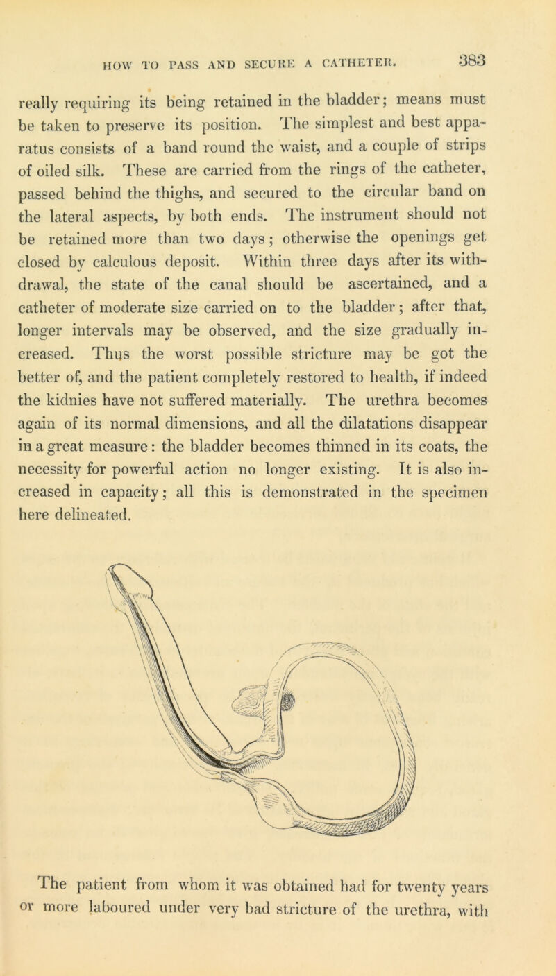 really requiring its being retained in the bladder; means must be taken to preserve its position. The simplest and best appa- ratus consists of a band round the waist, and a couple of strips of oiled silk. These are carried from the rings of the catheter, passed behind the thighs, and secured to the circular band on the lateral aspects, by both ends. The instrument should not be retained more than two days; otherwise the openings get closed by calculous deposit. Within three days after its with- drawal, the state of the canal should be ascertained, and a catheter of moderate size carried on to the bladder; after that, longer intervals may be observed, and the size gradually in- creased. Thus the worst possible stricture may be got the better of, and the patient completely restored to health, if indeed the kidnies have not suffered materially. The urethra becomes again of its normal dimensions, and all the dilatations disappear in a great measure: the bladder becomes thinned in its coats, the necessity for powerful action no longer existing. It is also in- creased in capacity; all this is demonstrated in the specimen here delineated. The patient from whom it was obtained bad for twenty years or more laboured under very bad stricture of the urethra, with