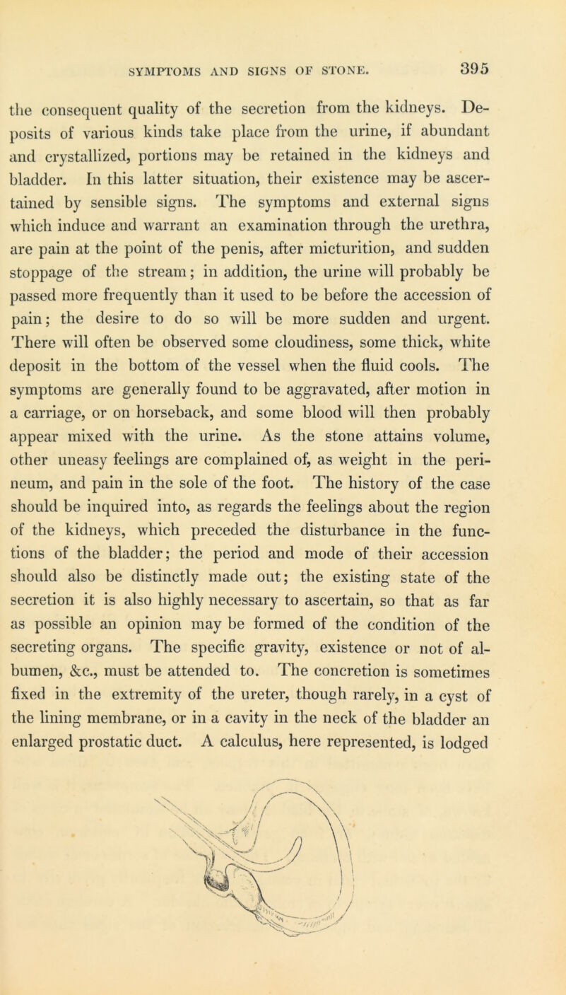 the consequent quality of the secretion from the kidneys. De- posits of various kinds take place from the urine, if abundant and crystallized, portions may be retained in the kidneys and bladder. In this latter situation, their existence may be ascer- tained by sensible signs. The symptoms and external signs which induce and warrant an examination through the urethra, are pain at the point of the penis, after micturition, and sudden stoppage of the stream; in addition, the urine will probably be passed more frequently than it used to be before the accession of pain; the desire to do so will be more sudden and urgent. There will often be observed some cloudiness, some thick, white deposit in the bottom of the vessel when the fluid cools. The symptoms are generally found to be aggravated, after motion in a carriage, or on horseback, and some blood will then probably appear mixed with the urine. As the stone attains volume, other uneasy feelings are complained of, as weight in the peri- neum, and pain in the sole of the foot. The history of the case should be inquired into, as regards the feelings about the region of the kidneys, which preceded the disturbance in the func- tions of the bladder; the period and mode of their accession should also be distinctly made out; the existing state of the secretion it is also highly necessary to ascertain, so that as far as possible an opinion may be formed of the condition of the secreting organs. The specific gravity, existence or not of al- bumen, &c., must be attended to. The concretion is sometimes fixed in the extremity of the ureter, though rarely, in a cyst of the lining membrane, or in a cavity in the neck of the bladder an enlarged prostatic duct. A calculus, here represented, is lodged