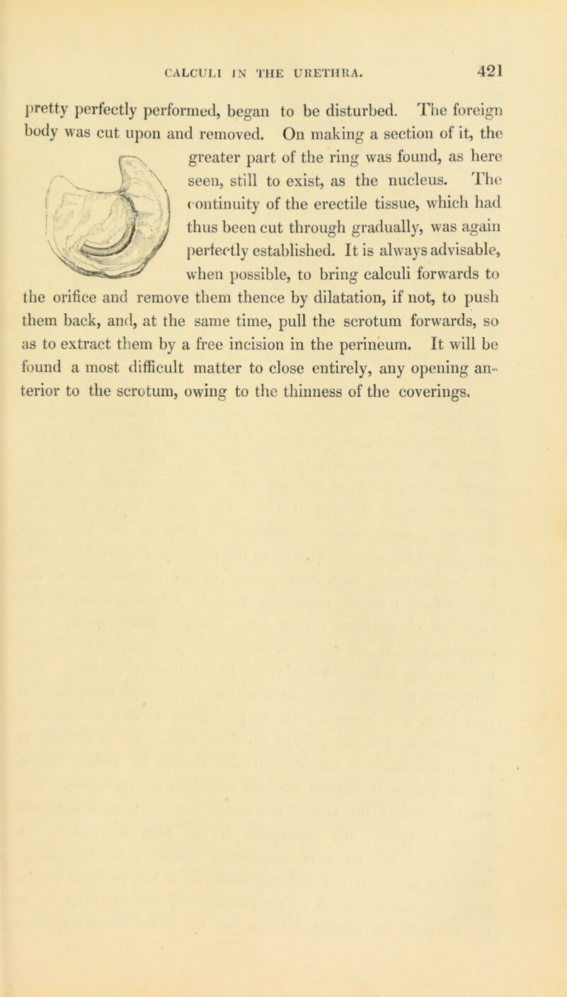 pretty perfectly performed, began to be disturbed. The foreign body was cut upon and removed. On making a section of it, the greater part of the ring was found, as here seen, still to exist, as the nucleus. The ( ontinuity of the erectile tissue, which had thus been cut through gradually, was again perfectly established. It is always advisable, when possible, to bring calculi forwards to the orifice and remove them thence by dilatation, if not, to push them back, and, at the same time, pull the scrotum forwards, so as to extract them by a free incision in the perineum. It will be found a most difficult matter to close entirely, any opening an- terior to the scrotum, owing to the thinness of the coverings.