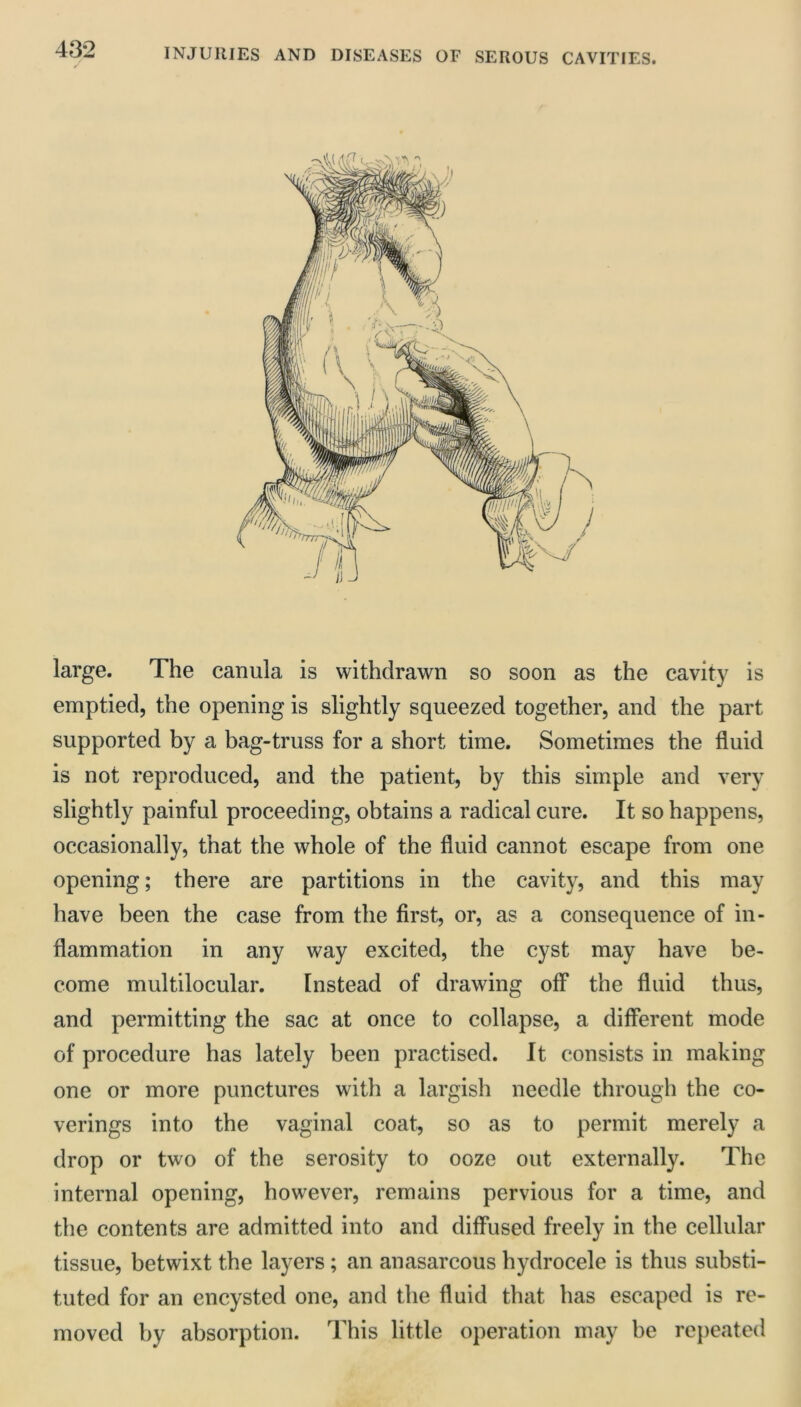 large. The canula is withdrawn so soon as the cavity is emptied, the opening is slightly squeezed together, and the part supported by a bag-truss for a short time. Sometimes the fluid is not reproduced, and the patient, by this simple and very slightly painful proceeding, obtains a radical cure. It so happens, occasionally, that the whole of the fluid cannot escape from one opening; there are partitions in the cavity, and this may have been the case from the first, or, as a consequence of in- flammation in any way excited, the cyst may have be- come multilocular. Instead of drawing off* the fluid thus, and permitting the sac at once to collapse, a different mode of procedure has lately been practised. It consists in making one or more punctures with a largish needle through the co- verings into the vaginal coat, so as to permit merely a drop or two of the serosity to ooze out externally. The internal opening, however, remains pervious for a time, and the contents are admitted into and diffused freely in the cellular tissue, betwixt the layers; an anasarcous hydrocele is thus substi- tuted for an encysted one, and the fluid that has escaped is re- moved by absorption. This little operation may be repeated