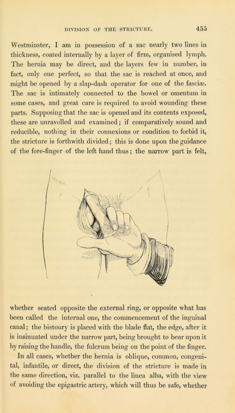 Westminster, I am in possession of a sac nearly two lines in thickness, coated internally by a layer of firm, organised lymph. The hernia may be direct, and the layers few in number, in fact, only one perfect, so that the sac is reached at once, and might be opened by a slap-dash operator for one of the fascim. The sac is intimately connected to the bowel or omentum in some cases, and great care is required to avoid wounding these parts. Supposing that the sac is opened and its contents exposed, these are unravelled and examined; if comparatively sound and reducible, nothing in their connexions or condition to forbid it, the stricture is forthwith divided; this is done upon the guidance of the fore-finger of the left hand thus; the narrow part is felt. whether seated opposite the external ring, or opposite what has been called the internal one, the commencement of the inguinal canal; the bistoury is placed with the blade flat, the edge, after it is insinuated under the narrow part, being brought to bear upon it by raising the handle, the fulcrum being on the point of the finger. In all cases, whether the hernia is oblique, common, congeni- tal, infantile, or direct, the division of the stricture is made in the same direction, viz. parallel to the linea alba, with the view of avoiding the epigastric artery, which will thus be safe, whether