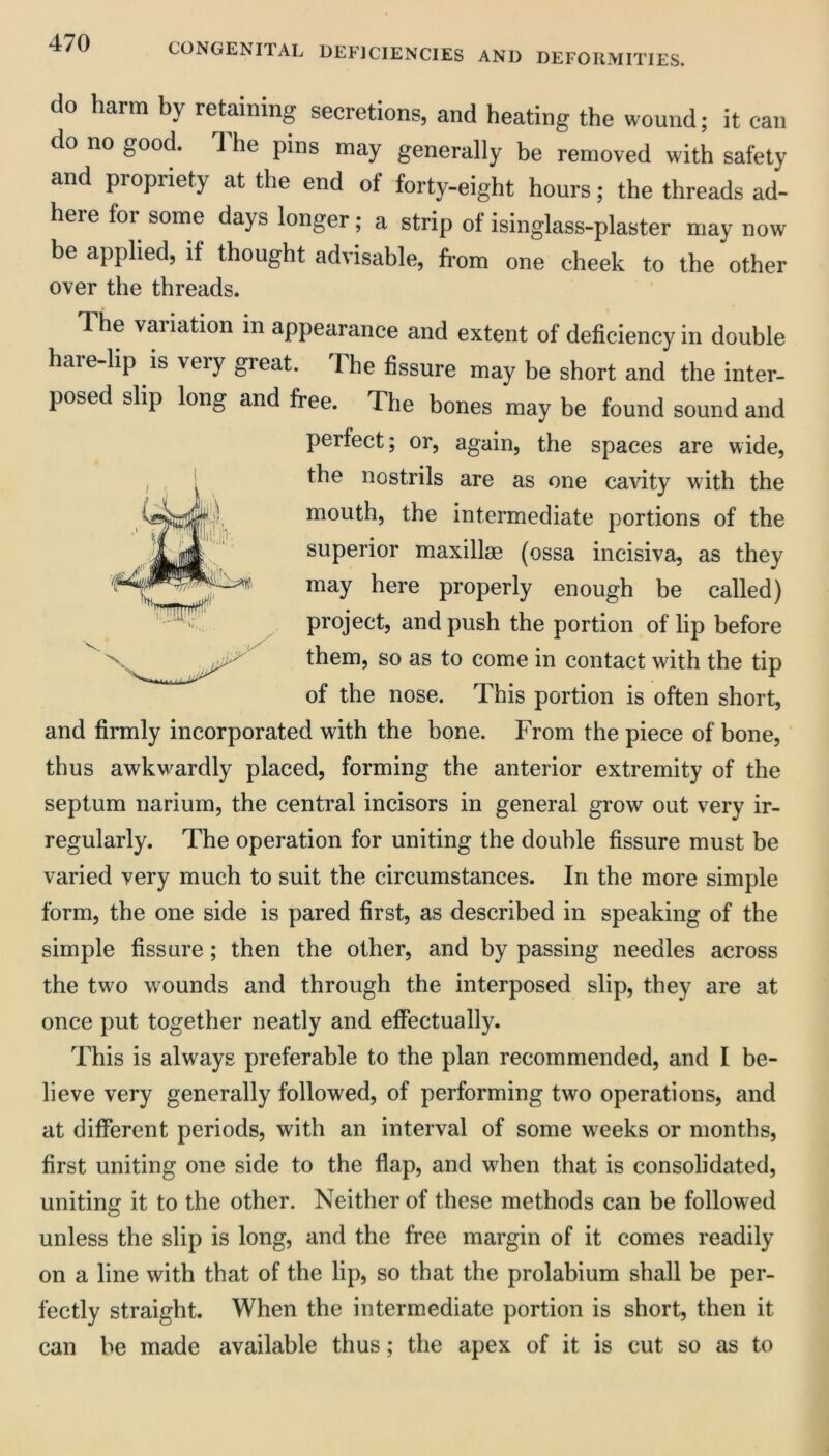 do harm by retaining secretions, and heating the wound; it can do no good. The pins may generally be removed with safely and propriety at the end of forty-eight hours; the threads ad- here for some days longer; a strip of isinglass-plaster may now be applied, if thought advisable, from one cheek to the other over the threads. .UJP^ 1 he variation in appearance and extent of deficiency in double hare-lip is very great. The fissure may be short and the inter- posed slip long and free. The bones may be found sound and perfect; or, again, the spaces are wide, the nostrils are as one cavity with the mouth, the intermediate portions of the superior maxillae (ossa incisiva, as they may here properly enough be called) project, and push the portion of lip before them, so as to come in contact with the tip of the nose. This portion is often short, and firmly incorporated with the bone. From the piece of bone, thus awkwardly placed, forming the anterior extremity of the septum narium, the central incisors in general grow out very ir- regularly. The operation for uniting the double fissure must be varied very much to suit the circumstances. In the more simple form, the one side is pared first, as described in speaking of the simple fissure; then the other, and by passing needles across the two wounds and through the interposed slip, they are at once put together neatly and effectually. This is always preferable to the plan recommended, and I be- lieve very generally followed, of performing two operations, and at different periods, with an interval of some weeks or months, first uniting one side to the flap, and when that is consolidated, uniting it to the other. Neither of these methods can be followed unless the slip is long, and the free margin of it comes readily on a line with that of the lip, so that the prolabium shall be per- fectly straight. When the intermediate portion is short, then it can be made available thus; the apex of it is cut so as to