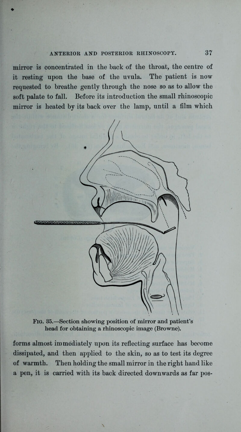 mirror is concentrated in the back of the throat, the centre of it resting upon the base of the uvula. The patient is now requested to breathe gently through the nose so as to allow the soft palate to fall. Before its introduction the small rhinoscopic mirror is heated by its back over the lamp, until a film which Fig. 35.—Section showing position of mirror and patient’s head for obtaining a rhinoscopic image (Browne). forms almost immediately upon its reflecting surface has become dissipated, and then applied to the skin, so as to test its degree of warmth. Then holding the small mirror in the right hand like a pen, it is carried with its back directed downwards as far pos-