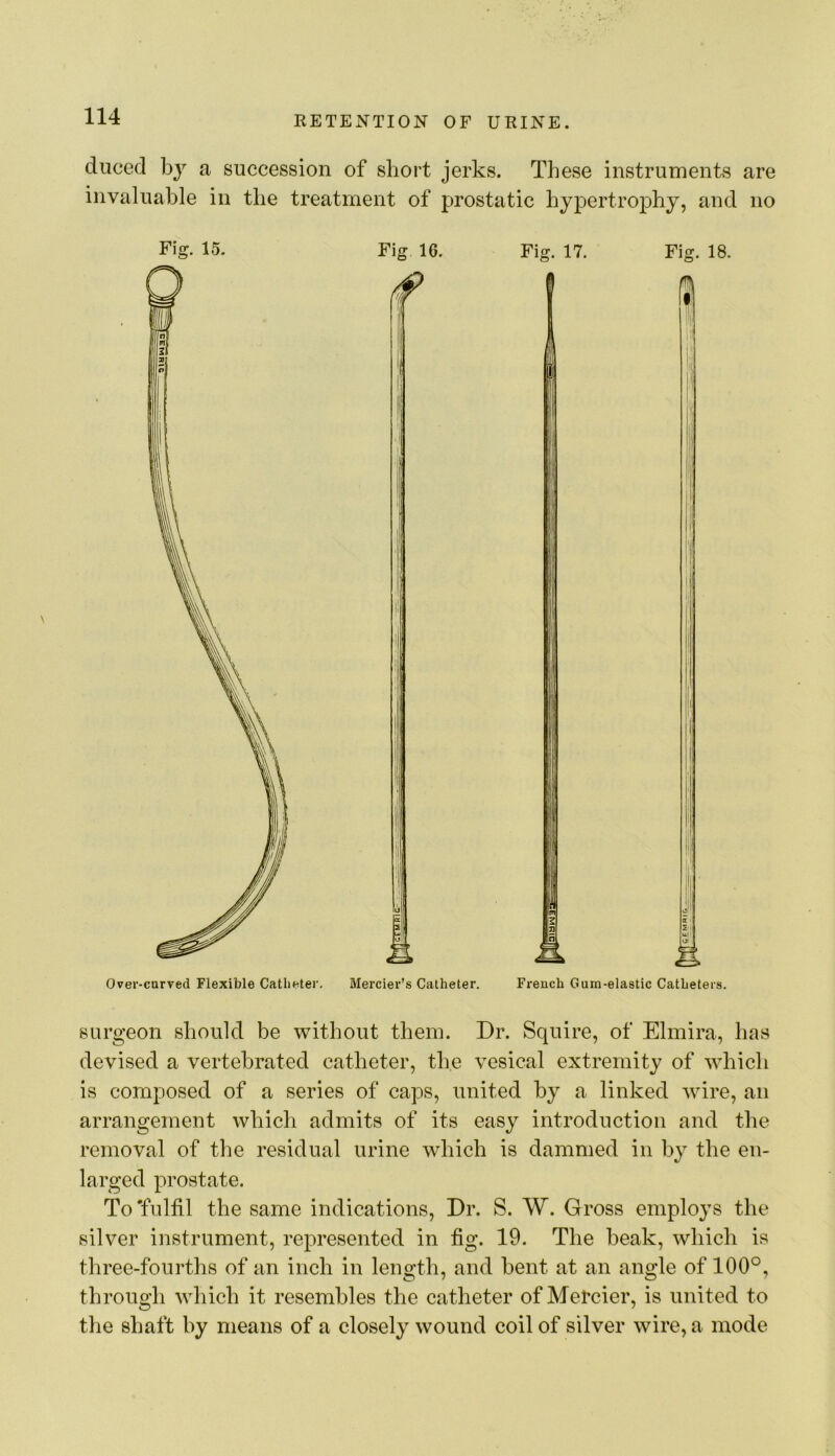 duced a succession of short jerks. These instruments are invaluable in the treatment of prostatic hypertrophy, and no Fig. 15. Fig 16. Over-curved Flexible Catheter, Mercier’s Catheter. Fig. 17. Fig. 18. French Gum-elastic Catheters. surgeon should be without them. Dr. Squire, of Elmira, has devised a vertebrated catheter, the vesical extremity of which is composed of a series of caps, united by a linked wire, an arrangement which admits of its easy introduction and the removal of the residual urine which is dammed in by the en- larged prostate. To'fulfil the same indications. Dr. S. W. Gross employs the silver instrument, represented in fig. 19. The beak, which is three-fourths of an inch in length, and bent at an angle of 100°, through which it resembles the catheter of Metcier, is united to the shaft by means of a closely wound coil of silver wire, a mode