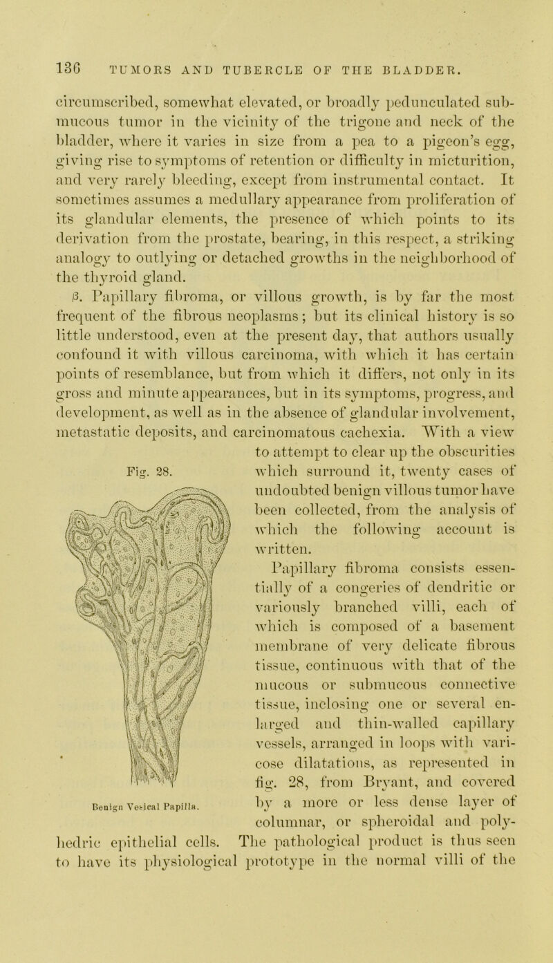 Fig. 28. circumscribed, somewhat elevated, or l)roadly pedunculated sub- mucous tumor in the vicinity of tlie trigone and neck of the bladder, where it varies in size from a pea to a pigeon’s egg, giving rise to symptoms of retention or difficulty iu micturition, and very rarely bleeding, except from instrumental contact. It sometimes assumes a medullary appearance from proliferation of its glandular elements, the presence of which points to its derivation from the prostate, bearing, in this respect, a striking analogy to outljdng or detached growths in tlie neighborhood of the thyroid gland. l3. Papillary fibroma, or villous growth, is by far the most frequent of the fibrous neoplasms; but its clinical history is so little understood, even at the present day, that authors usually confound it with villous carcinoma, with which it has certain points of resemblance, but from which it difiers, not only in its gross and minute appearances, but in its symptoms, progress, and development, as well as in the absence of glandular involvement, metastatic deposits, and carcinomatous cachexia. With a view to attempt to clear up the obscurities which surround it, twent}^ cases of undoubted benio^n villous tumor have been collected, from the analysis of 7 t/ which the following account is written. Papillary fibroma consists essen- tially of a congeries of dendritic or variously branched villi, each of which is composed of a basement membrane of very delicate fibrous tissue, continuous with that of the mucous or submucous connective tissue, inclosino’ one or several en- larged and thin-walled capillary vessels, arranged in loops with vari- cose dilatations, as represented in fio\ 28, from Bryant, and covered ly a more or less dense layer of columnar, or spheroidal and pol}^- hedric e])ithelial cells. The pathological product is thus seen to have its physiological prototype in the normal villi of the Beaign Vefcical Papilla.