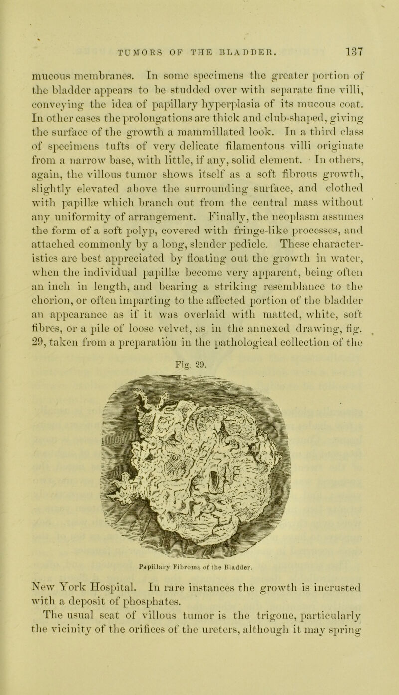 mucous membranes. In some speeimeus the greater i)Oi-tiou of the bladder appears to be studded over with separate flue villi, conveying tlie idea of papillary hyperplasia of its mucous coat. In other cases the prolongations are thick and club-shaped, gi ving tlie surface of the growth a mammillated look. In a third class of specimens tufts of very delicate tilamentous villi originate from a narrow base, with little, if any, solid element. In others, again, the villous tumor shows itself as a soft fibrous growth, slightl} elevated above the surrounding surface, aud clothed with papilla?, which branch out from the central mass Avithout any uniformity of arrangement. Finally, the neoplasm assumes the form of a soft polyp, coA^ered Avith fringe-like processes, and attached commonl}^ by a long, slender pedicle. These character- istics are best appreciated by fioating out the groAvth in Avater, Avhen the indiAudual papillre become veiy apparent, being often an inch in length, and bearing a striking resemblance to the chorion, or often imparting to the affected portion of the bladder an appearance as if it Avas overlaid Avith matted, Avhite, soft fibres, or a pile of loose A^elvet, as in the annexed draAving, fig. 29, taken from a preparation in the pathological collection of tlie Fig. 29. Papillary Fibroma of the Bladder. XeAv York Hospital. In rare instances the growth is incrusted Avith a deposit of phos[)liates. The usual seat of villous tumor is the trigone, particularly the vicinity of the orifices of the ureters, although it may spring