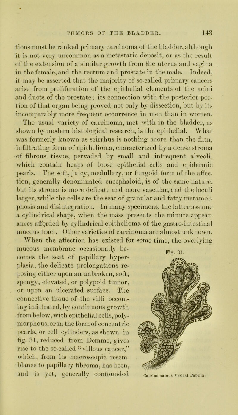 tions must be ranked primaiy earcinoma of the bladder, altliougli it is not very uncommon as a metastatic deposit, or as the result of the extension of a similar growth from the uterus and vagina in the female, and the rectum and prostate in the male. Indeed, it may be asserted that the majority of so-called primary cancers arise from proliferation of the epithelial elements of the acini and ducts of the prostate; its connection with the posterior por- tion of that organ being proved not only b}^ dissection, but by its incomparably more frequent occurrence in men than in women. The usual variety of carcinoma, met with in the bladder, as shown by modern histological research, is the epithelial. Wliat was formerly known as sciri'hus is nothing more than the firm, infiltrating form of epithelioma, characterized by a dense stroma of fibrous tissue, pervaded by small and infrequent alveoli, which contain heaps of loose epithelial cells and e[iidermic pearls. The soft, juicy, medullary, or fungoid form of the affec- tion, generally denominated encephaloid, is of the same nature, but its stroma is more delicate and more vascular, and the loculi larger, while the cells are the seat of granular and fatty metamor- phosis and disintegration. In many specimens, the latter assume a cylindrical shape, when the mass presents the minute appear- ances afforded by cylindrical epithelioma of the gastrointestinal mucous tract. Other varieties of carcinoma are almost unknown. When the attection has existed for some time, the overlying mucous membrane occasionally be- comes the seat of papillary hyper- plasia, the delicate prolongations re- posing either upon an unbroken, soft, spongy, elevated, or polypoid tumor, or upon an ulcerated surface. The connective tissue of the villi becom- ing infiltrated, by continuous growth from below, with epithelial cells, poly- morphous, or ill the form of concentric jiearls, or cell cylinders, as shown in fig. 31, reduced from Demme, gives rise to the so-called “ villous cancer,” which, from its macroscopic resem- blance to papillary fibroma, has been, and is yet, generally confounded Fig. 31. Ciirciuornatous Vesical Papilla.