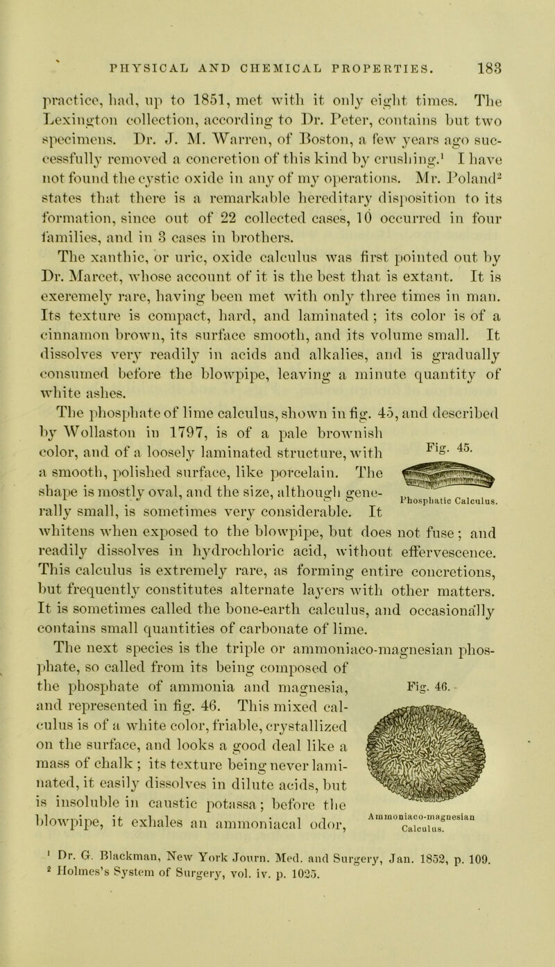 ]H’actico, bad, np to 1851, met with it only ei«;lit times. The Lexiiio'ton collection, according to ])r. Peter, contains hut two specimens. Dr. J. M. Warren, of Boston, a few years ago suc- cessfully removed a concretion of this kind by crushing.* I have not found the cystic oxide in any of my operations. Mr. Poland- states that there is a remarkable hereditary disposition to its formation, since out of 22 collected cases, 10 occurred in four iamilies, and in 3 cases in brothers. The xanthic, or uric, oxide calculus was first pointed out by Dr. Marcet, whose account of it is the best that is extant. It is exeremely rare, having been met with only three times in man. Its texture is compact, hard, and laminated; its color is of a cinnamon brown, its surface smooth, and its volume small. It dissolves very readily in acids and alkalies, and is gradually consumed before the blowpipe, leaving a minute quantity of white ashes. The phosphate of lime calculus, shown in fig. 45, and described by Wollaston in 1797, is of a pale brownish color, and of a loosely laminated structure, wdth a smooth, polished surface, like porcelain. The shape is mostly oval, and the size, althous-h o;ene- ^ r> n Phosphatic Calculus. rally small, is sometimes very considerable. It whitens when exposed to the blowpipe, but does not fuse; and readily dissolves in hydrochloric acid, without effervescence. This calculus is extremely rare, as forming entire concretions, but frequently constitutes alternate layers with other matters. It is sometimes called the bone-earth calculus, and occasionally contains small quantities of carbonate of lime. The next species is the triple or ammoniaco-magnesian phos- phate, so called from its being composed of the phosphate of ammonia and magnesia, and represented in fig. 46. This mixed cal- culus is of a white color, friable, crystallized on the surface, and looks a good deal like a mass of chalk ; its texture beino; never lanii- nated, it easily dissolves in dilute acids, but is insoluble in caustic potassa; before tlie l)lowpipe, it exhales an ammoniacal odor, ' Dr. G. Blackman, Ncav York Journ. Med. and Surgery, Jan. 1853, p. 109. 2 Holmes’s System of Surgery, vol. iv. p. 1035. Fig. 46. - Aminoniaco-rnagnesiaa