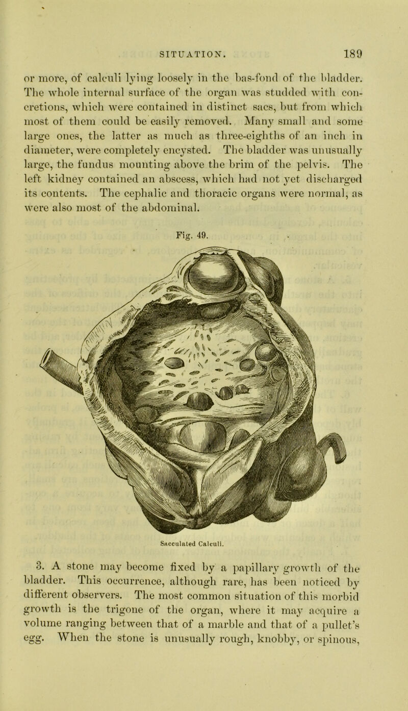 or more, of calculi lying loosely in the l)as-foiul of the bladder. The whole interiuil surface of the or^au was studded with cou- cretions, which were contained in distinct sacs, hut from which most of them could be easily removed. Many small and some large ones, the latter as much as three-eigliths of an inch in diameter, were completely encysted. The bladder was unusually large, the fundus mounting above the brim of the pelvis. The left kidney contained an abscess, which had not yet discharged its contents. The ceplialic and thoracic organs were normal, as were also most of the abdominal. Fig. 49. Sacculated Calculi. 3. A stone may become fixed by a papillary growth of the bladder. This occurrence, although rare, has been noticed by difi:erent observers. The most common situation of this morbid growth is the trigone of the organ, where it may acquire a volume ranging between that of a marble and that of a pullet’s egg. When the stone is unusually rough, knobby, or spinous,