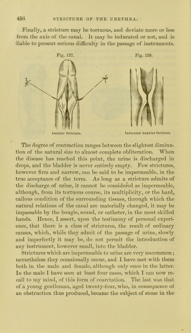 Finally, a stricture may be tortuous, and deviate more or less from the axis of the canal. It may be indurated or not, and is liable to present serious difficulty in the passage of instruments. Fig. 137. Fig. 128. The degree of contraction ranges between the slightest diminu- tion of the natural size to almost complete obliteration. When the disease has reached this point, the urine is discharged in drops, and the bladder is never entirely empty. Few strictures, however firm and narrow, can be said to be impermeable, in the true acceptance of the term. As long as a stricture admits of the discharge of urine, it cannot be considered as impermeable, although, from its tortuous course, its multiplicity, or the hard, callous condition of the surrounding tissues, through which the natural relations of the canal are materially changed, it may be impassable by the bougie, sound, or catheter, in the most skilled hands. Hence, I assert, upon the testimony of personal experi- ence, that there is a class of strictures, the result of ordinary causes, which, while they admit of the passage of urine, slowly and imperfectly it may be, do not permit the introduction of any instrument, however small, into the bladder. Strictures which are impermeable to urine are very uncommon ; nevertheless they occasionally occur, and I have met with them both in the male and female, although only once in the latter. In the male I have seen at least four cases, which I can now re- call to my mind, of this form of coarctation. The last was that of a young gentleman, aged twenty-four, who, in consequence of an obstruction thus produced, became the subject of stone in the