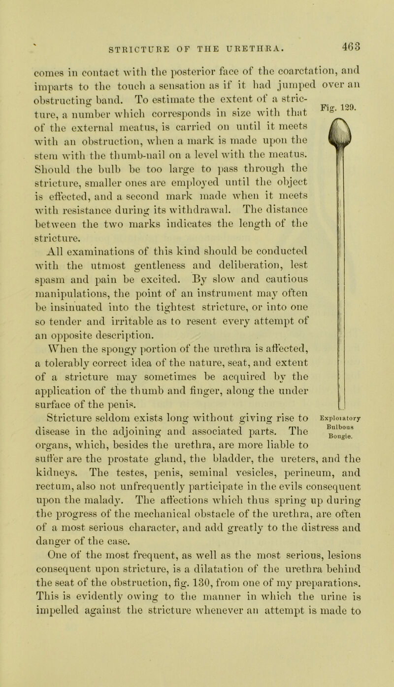 Fig. 120. comes in contact Avitli tlie posterior face of the coarctation, and imparts to the touch a sensation as if it had jumped over an ohstrnctino; band. To estimate the extent ot a stric- tnre, a niimher wliich corresponds in size with that of the external meatns, is carried on until it meets with an obstruction, when a mark is made upon the stem with the thumb-nail on a level with the meatus. Should the bulb be too large to ]>ass through the stricture, smaller ones are emi)loyed until the object is effected, and a second mark made when it meets with resistance during its withdrawal. The distance between the two marks indicates the length of the stricture. All examinations of this kind should he conducted Avith the utmost gentleness and deliberation, lest spasm and pain be excited. By slow and cautious manipulations, the point of an instrument may often he insinuated into the tio’htest stricture, or into one so tender and irritable as to resent every attempt of an opposite description. When the spongy portion of the urethra is affected, a tolerably correct idea of the nature, seat, and extent of a stricture may sometimes he acquired by the application of the thumb and finger, along the under surface of the penis. Stricture seldom exists long ivithout giving rise to Expioiatory disease in the adjoining and associated parts. The organs, Avhich, besides the urethra, are more liable to suffer are the prostate gland, tlie bladder, the ureters, and the kidneys. The testes, penis, seminal Amsicles, perineum, and rectum, also not unfrequently participate in the eAuls consequent upon the malady. The affections Avhich thus spring np during the progress of the mechanical obstacle of the urethra, are often of a most serious character, and add greatly to the distress and danger of the case. One of the most frequent, as Avell as the most serious, lesions consequent upon stricture, is a dilatation of the urethra behind the seat of the obstruction, fig. 130, from one of mj^ preparations. This is evidently owing to the manner in Avhich the urine is impelled against the stricture Avhenever an attempt is made to
