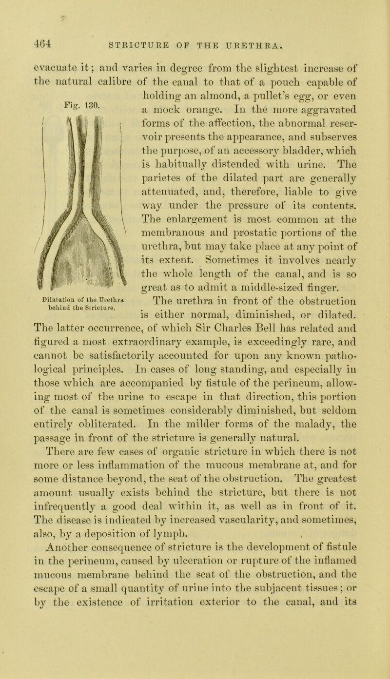 evacuate it; and varies in degree from the slightest increase of the natural calibre of tlie canal to that of a pouch capable of holding an almond, a pullet’s egg, or even a mock orange. In the more aggravated forms of the affection, the abnormal reser- voir presents the appearance, and subserves the purpose, of an accessoiy bladder, which is habitually distended with urine. The parietes of the dilated part are generally attenuated, and, therefore, liable to give way under the pressure of its contents. The enlargement is most common at the membranous and prostatic portions of the urethra, but may take place at any point of its extent. Sometimes it involves nearly the whole length of the canal, and is so great as to admit a middle-sized finger. The urethra in front of the obstruction is either normal, diminished, or dilated. The latter occurrence, of which Sir Charles Bell has related and figured a most extraordinary example, is exceedingly rare, and cannot be satisfactorily accounted for upon any known patho- logical principles. In cases of long standing, and especiall} in those which are accompanied by fistule of the perineum, allow- ing most of the urine to escape in that direction, this portion of the canal is sometimes considerabl}^ diminished, but seldom entirely obliterated. In the milder forms of the malady, the passage in front of the stricture is generally natural. There are few cases of organic stricture in which there is not more or less inflammation of the mucous membrane at, and for some distance beyond, the seat of the obstruction. The greatest amount usually exists behind the stricture, but tliere is not infrequently a good deal within it, as well as in front of it. The disease is indicated by increased vascularity, and sometimes, also, by a deposition of lymph. Another consequence of stricture is the development of fistule in the perineum, caused bj^ ulceration or rupture of the inflamed mucous membrane behind the seat of the obstruction, and the escape of a small quantity of urine into the subjacent tissues; or by the existence of irritation exterior to the canal, and its Fig. 130. Dilatation of the Urethra behind the Stricture.