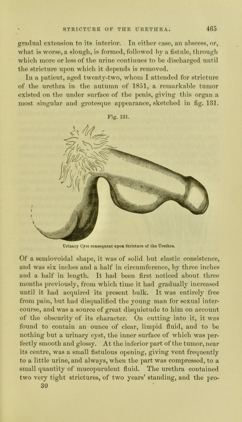 gradual extension to its interior. In either case, an abscess, or, what is worse, a slough, is formed, folloAved by a fistule, through which more or less of the urine continues to he discharged until the stricture upon which it depends is removed. In a patient, aged twenty-two, whom I attended for stricture of the urethra in the autumn of 1851, a remarkable tumor existed on the under surface of the penis, giving this organ a most singular and grotesque appearance, sketched in fig. 131. Fig. 131. Urinary Cyst consequent upon Stricture of the Urethra. Of a semiovoidal shape, it was of solid hut elastic consistence, and was six inches and a half in circumference, by three inches and a half in length. It had been first noticed about three months previously, from which time it had gradually increased until it had acquired its present bulk. It was entirely free from pain, but had disqualified the young man for sexual inter- course, and was a source of great disquietude to him on account of the obscurity of its character. On cutting into it, it was found to contain an ounce of clear, limpid fluid, and to be nothing but a urinary cyst, the inner surface of which was per- fectly smooth and glossy. At the inferior part of the tumor, near its centre, was a small fistulous opening, giving vent frequently to a little urine, and always, when the part was compressed, to a small quantity of mucopurulent fluid. The urethra contained two very tight strictures, of two years’ standing, and the pro- 30