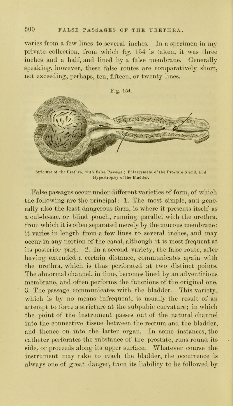 varies from a few lines to several indies. In a specimen in my private collection, from whidi fig. 154 is taken, it was three indies and a half, and lined hy a fixlse niemhrane. Generally speaking, however, these false routes are comparatively short, not exceeding, perhaps, ten, fifteen, or twenty lines. Fig. 154. Stricture of the Urethra, witli False Passage ; Enlargement of the Prostate Gland, and Hypertrophy of the Bladder. False passages occur under different varieties of form, of which the following are the principal: 1. The most simple, and gene- rally also the least dangerous form, is where it presents itself as a cul-de-sac, or blind pouch, running parallel with the urethra, from which it is often separated merely by the mucous membrane: it varies in length from a few lines to several inches, and may occur in any portion of the canal, although it is most frequent at its posterior part. 2. In a second variety, the false route, after having extended a certain distance, communicates again with the urethra, which is thus perforated at two distinct points. The abnormal channel, in time, becomes lined by an adventitious membrane, and often performs the functions of the origiiial one. 3. Tlie passage communicates with the bladder. This variety, which is by no means infrequent, is usually the result of an attempt to force a stricture at the subpubic curvature; in which the point of the instrument passes out of the natural channel into the connective tissue between the rectum and the bladder, and thence on into the latter organ. In some instances, the catheter pei'forates the substance of the prostate, runs round its side, or proceeds along its upper surface. Whatever course the instrument may take to reach the bladder, tlie occurrence is always one of great danger, from its liability to be followed by