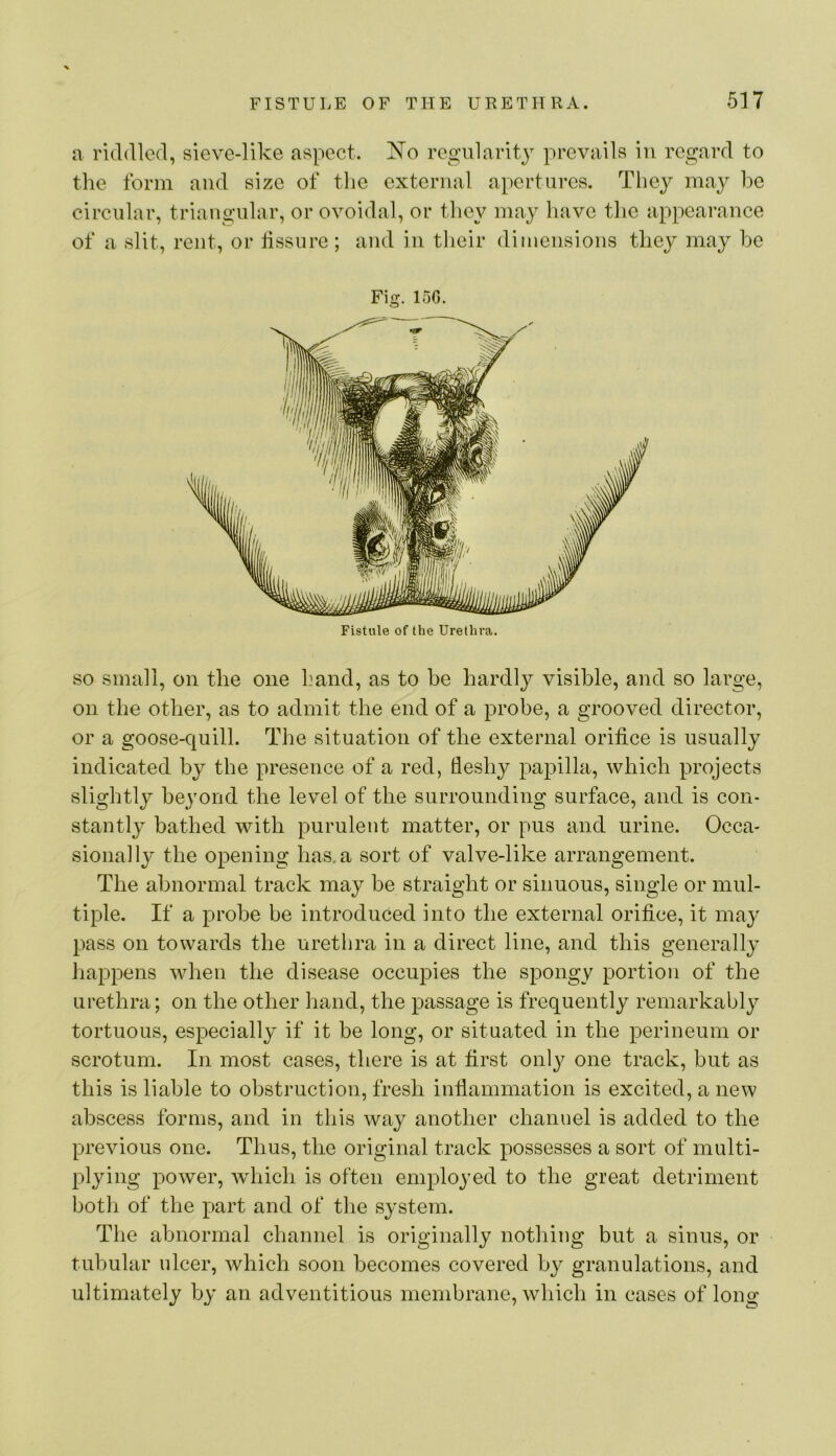 a riddled, sievc-like aspect. Ko regularity prevails in regard to the form and size of the external apertures. They may he circular, triangular, or ovoidal, or they may have the appearance of a slit, rent, or lissnre ; and in tlieir dimensions they may he Fig. 15G. Fistule of the Urethra. SO small, on the one hand, as to he hardly visible, and so large, on the other, as to admit the end of a probe, a grooved director, or a goose-quill. The situation of the external orifice is usually indicated by the presence of a red, fleshy papilla, which projects slightly beyond the level of the surrounding surface, and is con- stantly bathed with purulent matter, or pus and urine. Occa- sionally the opening has. a sort of valve-like arrangement. The abnormal track may be straight or sinuous, single or mul- tiple. If a probe be introduced into the external orifice, it may pass on towards the urethra in a direct line, and this generally happens when the disease occupies the spongy portion of the urethra; on the other hand, the passage is frequently remarkably tortuous, especially if it be long, or situated in the perineum or scrotum. In most cases, there is at first only one track, but as this is liable to obstruction, fresh inflammation is excited, a new abscess forms, and in this way another channel is added to the previous one. Thus, the original track possesses a sort of multi- plying power, Avhich is often employed to the great detriment botli of the part and of the system. The abnormal channel is originally nothing but a sinus, or tubular ulcer, Avhich soon becomes covered by granulations, and ultimately by an adventitious membrane, which in cases of long