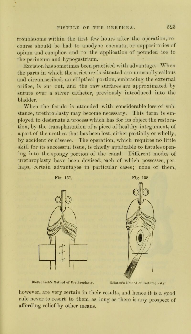 troublesome witliin the first few hours after the operation, re- course should be had to anodyne enemata, or suppositories of opium and camphor, and to the application of pouuded ice to the perineum and hypogastriurn. Excision has sometimes been practised with advantage. When the parts in which the stricture is situated are unusually callous and circumscribed, an elliptical portion, embracing the external orifice, is cut out, and the raw surfaces are approximated by suture over a silver catheter, previously introduced into the bladder. When the fistule is attended with considerable loss of sub- stance, urethroplasty may become necessary. This term is em- ployed to designate a process which has for its object the restora- tion, by the transplantation of a piece of healthy integument, of apart of the urethra that has been lost, either partially or wholly, by accident or disease. The operation, which requires no little skill for its successful issue, is chiefly applicable to fistules open- ing into the spongy portion of the canal. Different modes of urethroplasty have been devised, each of which possesses, per- haps, certain advantages in j>articular cases; none of tliem. however, are very certain in their results, and hence it is a wod rule never to resort to them as long as there is any prospect of affording relief by other means. Fig. 157. Fig. 158. Dieffenbach’s Method of Urethroplasty. Nelalon’s Method of Urethroplasty,