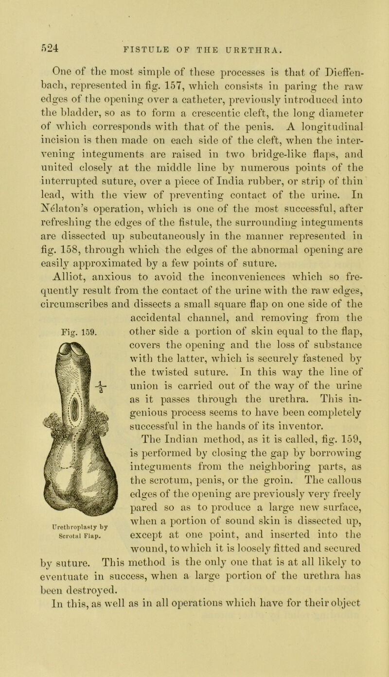 One of the most simple of these processes is that of Dieffen- bach, represented in hg. 157, wliich consists in paring the raw edges of the opening over a catheter, previously introduced into the bladder, so as to form a crescentic cleft, the long diameter of which corresponds with that of the penis. A longitudinal incision is then made on each side of the cleft, when the inter- vening integuments are raised in two hridge-like flaps, and united closely at the middle line by numerous points of the interrupted suture, over a piece of India rubber, or strip of thin lead, with the view of preventing contact of the urine. In H^laton’s operation, which is one of the most successful, after refreshing the edges of the fistule, the surrounding integuments are dissected up subcutaneously in the manner represented in fig. 158, through which the edges of the abnormal opening are easily approximated by a few points of suture. Alliot, anxious to avoid the inconveniences which so fre- quently result from the contact of the urine with the raw edges, circumscribes and dissects a small square flap on one side of the accidental channel, and removing from the other side a portion of skin equal to the flap, covers the opening and the loss of substance with the latter, which is securely fastened by the twisted suture. In this way the line of union is carried out of the way of the urine as it passes through the urethra. This in- genious process seems to have been completely successful in the hands of its inventor. The Indian method, as it is called, fig. 159, is performed by closing the gap by borrowing integuments from the neighboring parts, as the scrotum, penis, or the groin. The callous edges of the opening are previously very freely pared so as to produce a large new surface, when a portion of sound skin is dissected up, excepit at one point, and inserted into tlie wound, to which it is loosely fitted and secured by suture. This method is the onl}- one that is at all likely to eventuate in success, when a large portion of the uretlira has been destroyed. In this, as well as in all operations which have for their object Fig. 159. Uretliroplasty by Scrotal Flap,