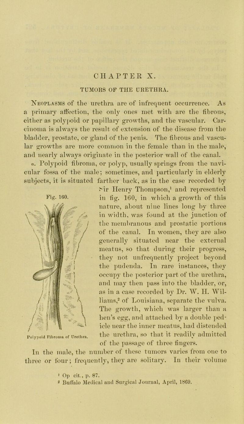 TUMORS OF THE URETHRA. Xeoplasms of the urethra are of infrequent occurrence. As a primary atfection, the only ones met with are tlie hbrous, either as polj-poid or papillary growths, and the vascular. Car- cinoma is always the result of extension of the disease from the bladder, prostate, or gland of the penis. The fibrous and vascu- lar growths are more common in the female than in the male, and nearly always originate in the posterior wall of the canal. a. Pol}q)oid fibroma, or polyp, usually springs from the navi- cular fossa of the male; sometimes, and particularly in elderly subjects, it is situated farther hack, as in the case recorded by J^ir Henry Thompson,* and represented Fig- HjO. in tig. 160, in which a growth of this nature, about nine lines long by three in width, was found at the junction of the memhranous and prostatic portions of the canal. In women, they are also generally situated near the external meatus, so that during their progress, the} not unfrequently project beyond the pudenda. In rare instances, they occupy the posterior part of the urethra, and may then pass into the bladder, or, as in a case recorded by Hr. W. II. AYil- liams,^ of Louisiana, separate the vulva. The growth, wliich was larger than a hen’s egg, and attached by a double ped- icle near the inner meatus, had distended the urethra, so that it readilv admitted of the passage of three fingers. In the male, the number of those tumors varies from one to three or four; frequently, they are solitary. In their volume ‘ Op cit., p, 87. 2 BiilTalo Medical and Surgical Journal, April, 1809.